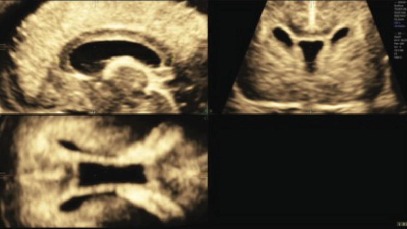 Evaluación del SNC fetal: protocolo y estructuras clave